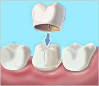 dental Crown