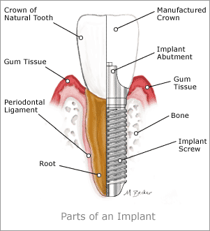 dental Implant