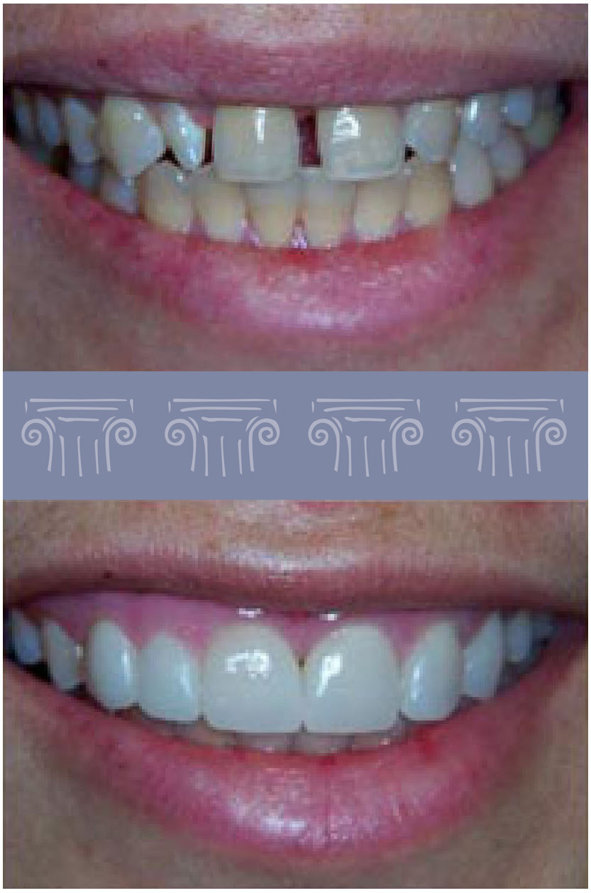 Porcelain Veneers 4