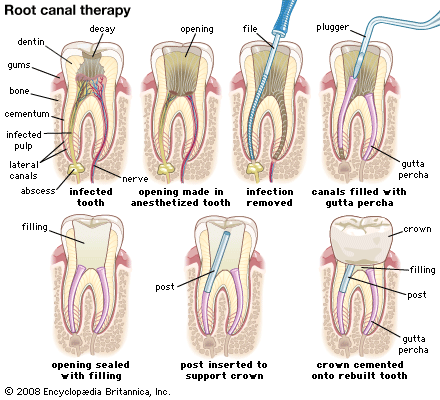 Root Canal therapy